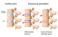 In a healthy spine, the vertebrae are separated by discs. In ankylosing spondylitis, the discs are inflamed, which eventually leads to fusion of the vertebrae, known as &quot;bamboo spine&quot;.